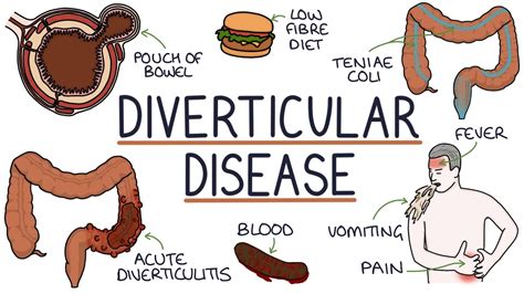 what symptoms are similar to diverticulitis